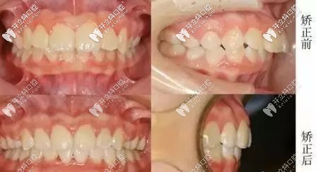 齙牙戴金屬矯正器矯正效果