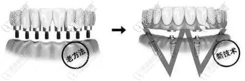 傳統(tǒng)種植牙和AII-ON-4種植的區(qū)別