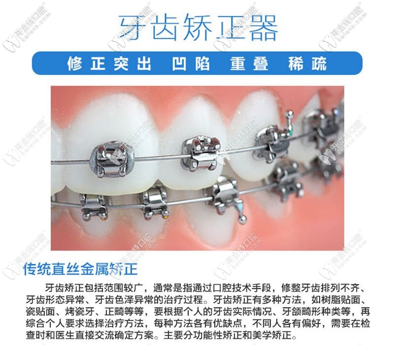 傳統(tǒng)的牙齒矯正 傳統(tǒng)的牙齒矯正