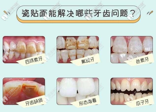 廣州圣貝口腔牙齒瓷貼面