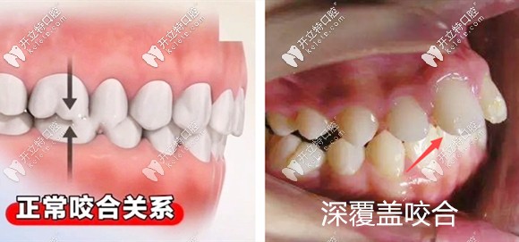 我的牙齒情況是屬于深覆蓋