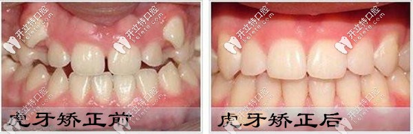 給深圳的菇?jīng)鰝?暢談我戴時代天使隱形牙套矯正虎牙的感受