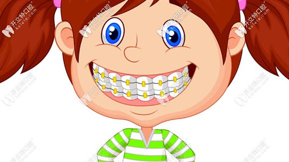 我是戴奧美科金屬自鎖牙套做的矯正