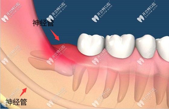 三亞拔智齒的價(jià)格為500元起 三亞拔智齒的價(jià)格為500元起