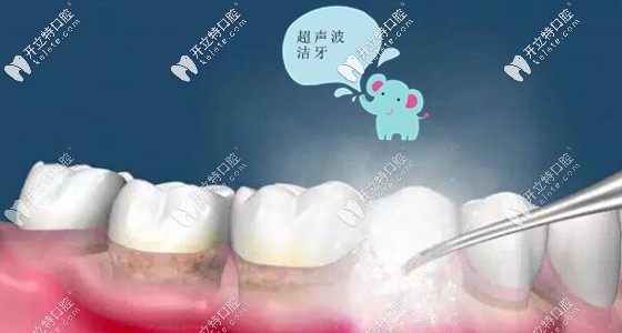 在三亞市洗牙要多少錢呢 在三亞市洗牙要多少錢呢