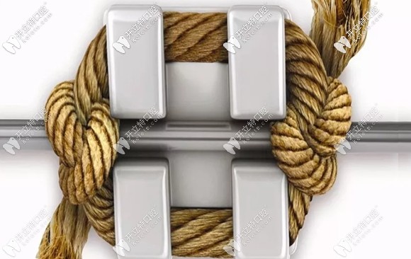 三亞微笑牙科金屬自鎖托槽矯正價(jià)格 三亞微笑牙科金屬自鎖托槽矯正價(jià)格