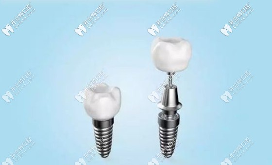 三亞正規(guī)牙科醫(yī)院種植牙參考價(jià)格 三亞正規(guī)牙科醫(yī)院種植牙參考價(jià)格