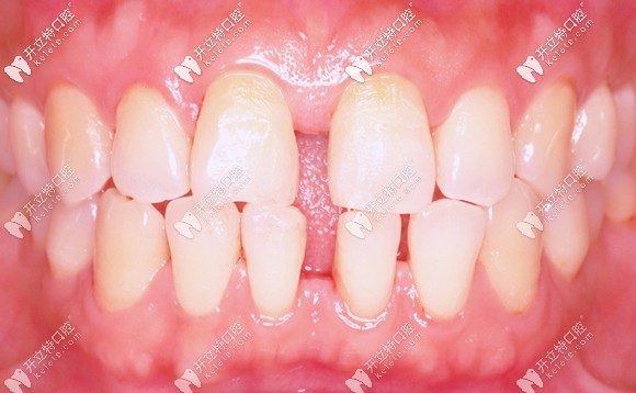 我關(guān)閉門牙縫隙前的照片