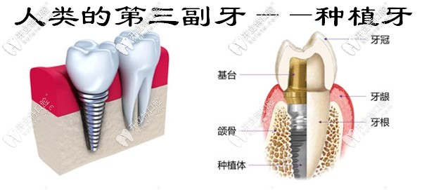 西安美奧口腔免費(fèi)送種植牙冠