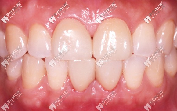 門牙剛做完瓷貼片后的效果