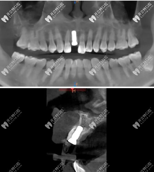 瑞士iti鈦親水BL 4.1mm*10mm種植體
