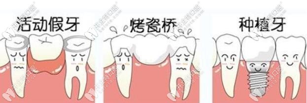牙齒缺失修復(fù)方式