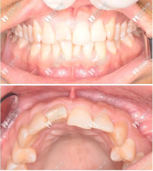 一例門牙外傷松動修復(fù)案例