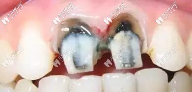 烤瓷牙黑線問題