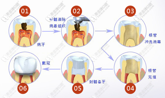 根管治療步驟圖解 根管治療步驟圖解
