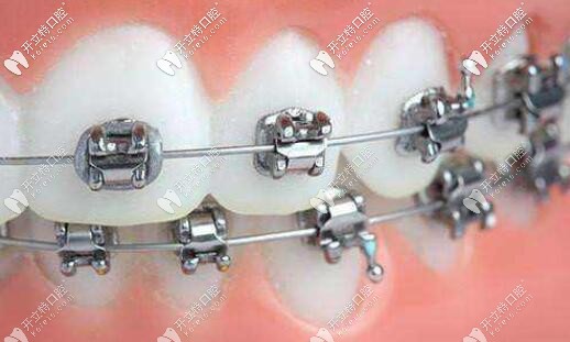 金屬自鎖托槽牙套