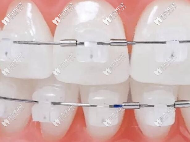 陶瓷自鎖托槽牙套圖片