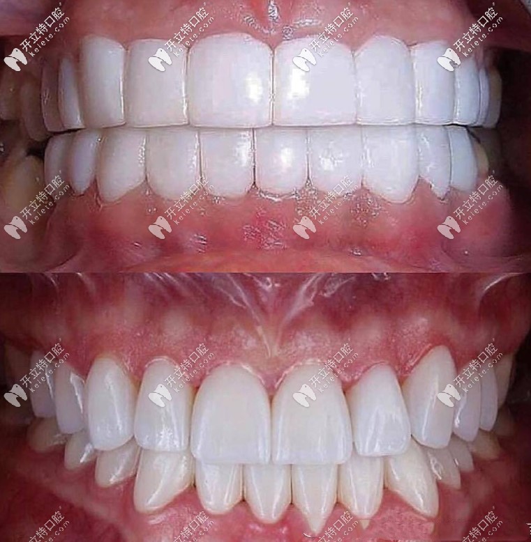 客在其他機(jī)構(gòu)做瓷貼面和佳美修復(fù)后對(duì)比