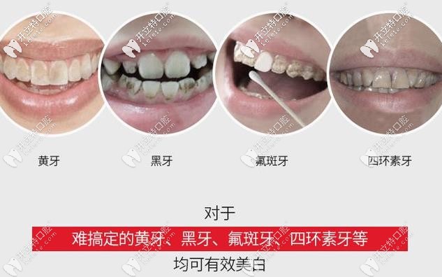  英國(guó)Wyman美白適用牙齒情況