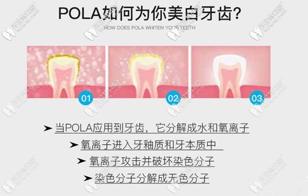 澳洲 SDI POLA 美白牙齒過(guò)程