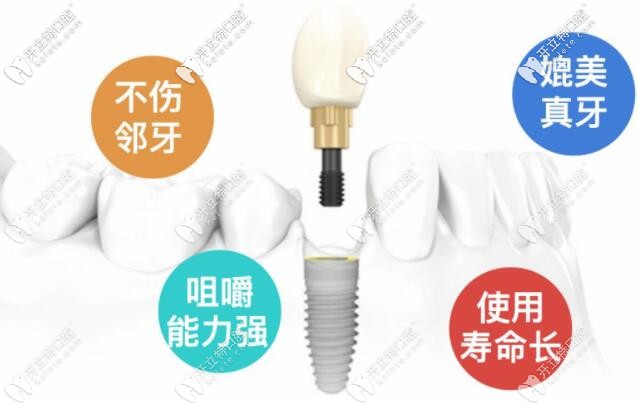 @深圳市民,南山區(qū)私立牙科做韓國登騰種植牙還不到5000塊