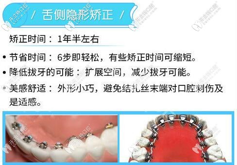 舌側(cè)隱形矯正優(yōu)勢(shì)