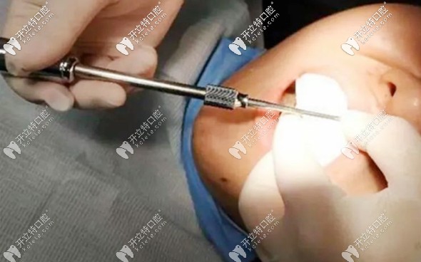 從網(wǎng)上購買的矯正器有效果嗎