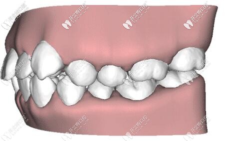 牙齒矯正示意圖 牙齒矯正示意圖
