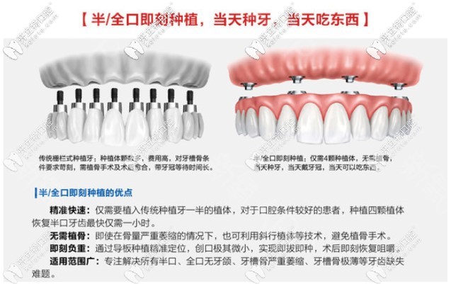 杭州美奧口腔即刻種植牙