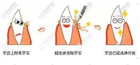 定期洗牙預(yù)防牙周病 定期洗牙預(yù)防牙周病