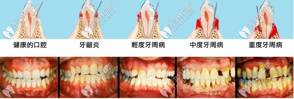 牙周病發(fā)展過(guò)程 牙周病發(fā)展過(guò)程
