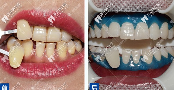 牙齒美白前后結(jié)果 牙齒美白前后結(jié)果