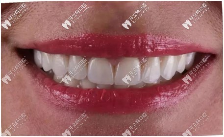 瓷貼面口腔效果圖