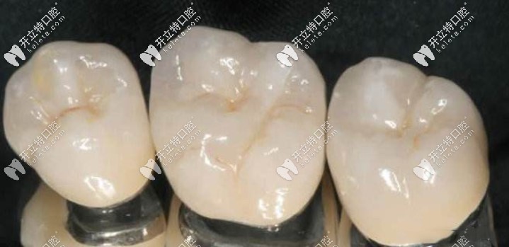 后牙金屬烤瓷牙