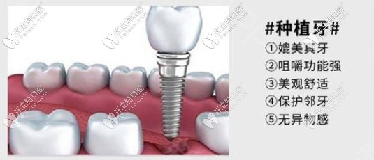 種植牙優(yōu)勢(shì)圖