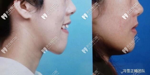 西安美奧口腔正畸案例