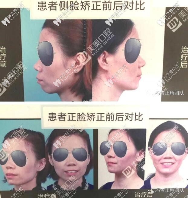 西安美奧口腔馮雪正畸團隊案例