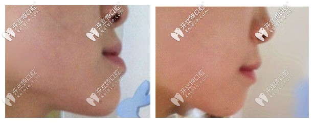 隱適美矯正地包天的效果圖 隱適美矯正地包天的效果圖