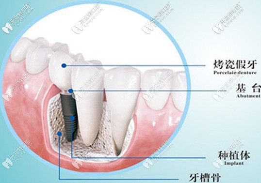 7800元的奧齒泰種植體對(duì)于12000元iti種植體