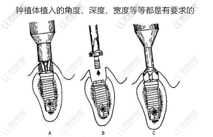 種植牙后牙床爛了可能是植體植入角度不對(duì)導(dǎo)致的