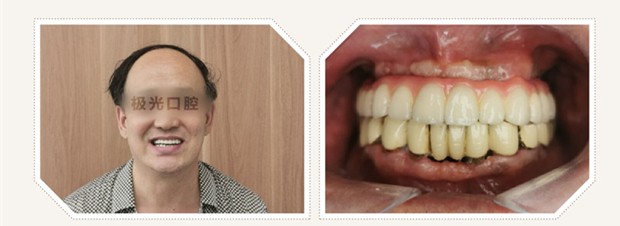 成都極光口腔上半口沒牙別戴活動假牙,在成都做4顆半口種植牙費(fèi)用也不貴