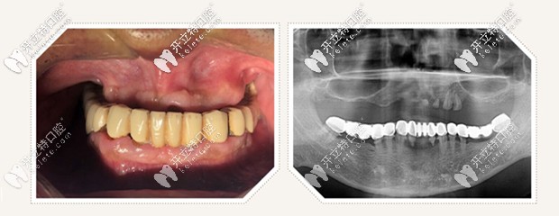 上半口沒牙怎么辦