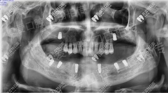 <!--<i data=20240703-sp></i>-->口腔醫(yī)院半口ALL-ON-6種植牙<span style= <!--<i data=20240703-sp></i>-->口腔醫(yī)院半口ALL-ON-6種植牙<span style=