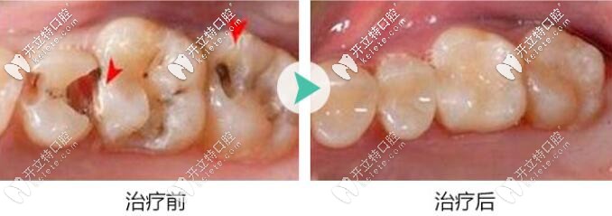 補牙前后對比