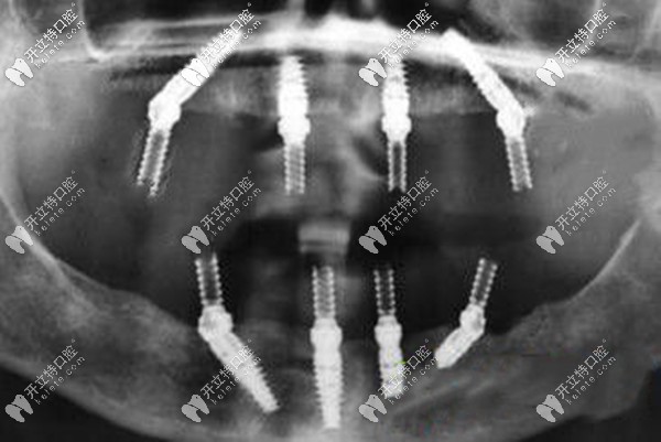 福州allon4全口種植牙價格