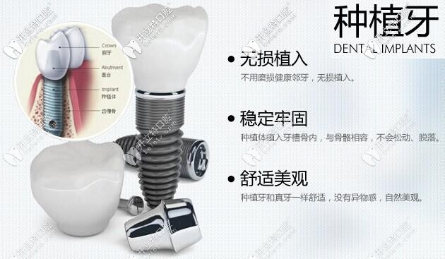 牙博士口腔種植牙價格