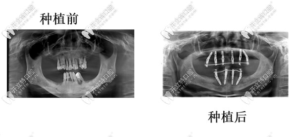 牙周炎全口缺失可以做種植牙嗎