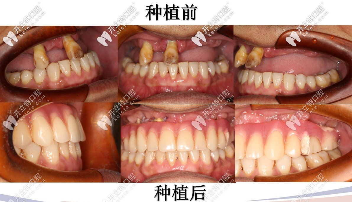 半口種植術(shù)前術(shù)后對比