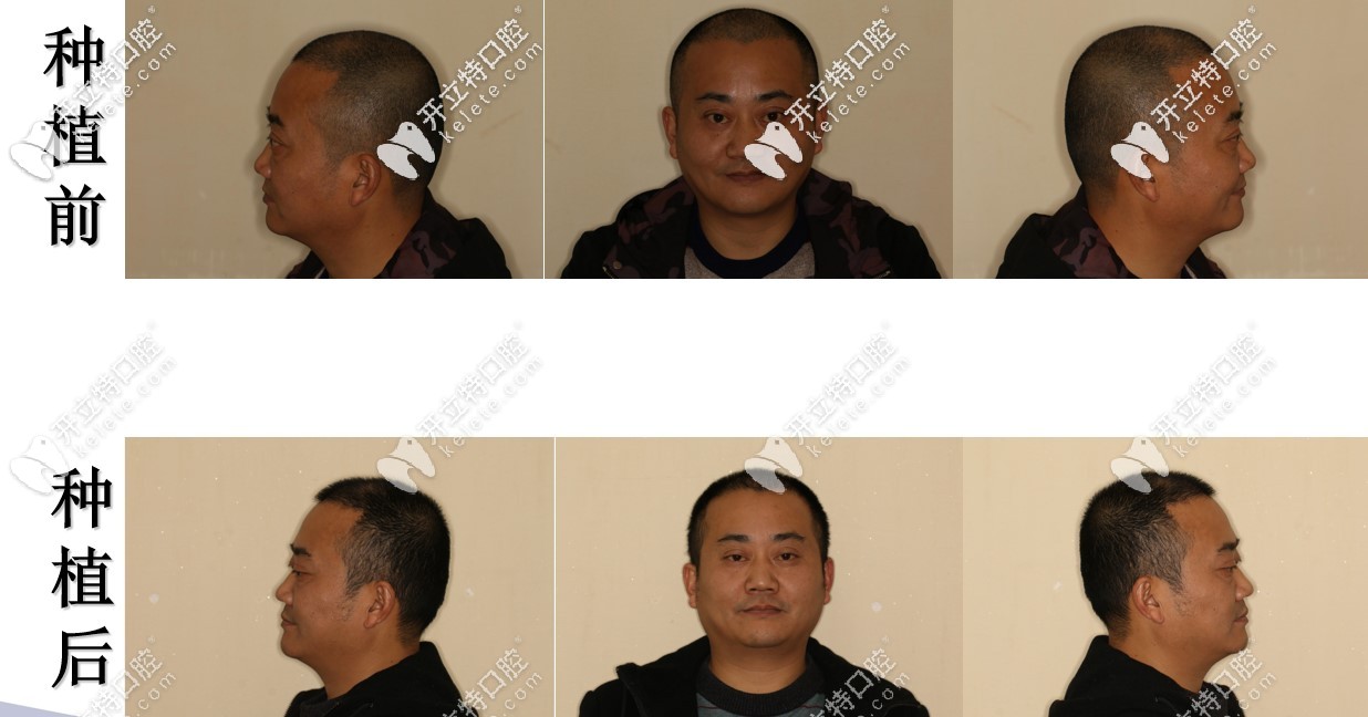 種植牙前后對比