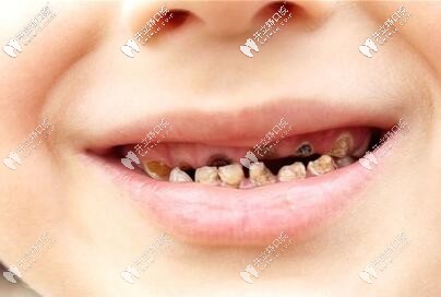 兒童蛀牙圖片